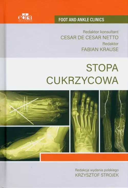 Stopa cukrzycowa - Książki